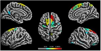 Cortical Thickness Changes in Chronic Ketamine Users